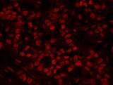 HFip1 / FIP1L1 Antibody - Detection of human FIP1 by immunohistochemistry. Sample: FFPE section of human breast carcinoma. Antibody: Affinity purified rabbit anti-FIP1 used at a dilution of 1:100. Detection: Red-fluorescent goat anti-rabbit IgG highly cross-adsorbed Antibody used at a dilution of 1:100.