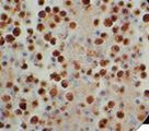 HHV-8 / HHV8 / KSHV Antibody - IHC of HHV-8 on FFPE Infected Pleura tissue. This image was taken for the unmodified form of this product. Other forms have not been tested.