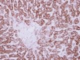 HIBADH Antibody - IHC of paraffin-embedded Breast ca, using HIBADH antibody at 1:250 dilution.