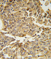 HIF1A / HIF1 Alpha Antibody - HIF1A Antibody IHC of formalin-fixed and paraffin-embedded lung carcinoma followed by peroxidase-conjugated secondary antibody and DAB staining.