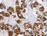 HINT2 Antibody - Immunohistochemistry of paraffin-embedded Human thyroid cancer using HINT2 Polyclonal Antibody at dilution of 1:50.