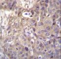 HIPK1 Antibody - HIPK1 Antibody immunohistochemistry of formalin-fixed and paraffin-embedded human breast carcinoma followed by peroxidase-conjugated secondary antibody and DAB staining.