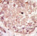 HIPK3 / FIST Antibody - Formalin-fixed and paraffin-embedded human cancer tissue reacted with the primary antibody, which was peroxidase-conjugated to the secondary antibody, followed by DAB staining. This data demonstrates the use of this antibody for immunohistochemistry; clinical relevance has not been evaluated. BC = breast carcinoma; HC = hepatocarcinoma.