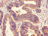 HIPK3 / FIST Antibody - Immunohistochemistry image of paraffin-embedded human colon cancer at a dilution of 1:100