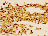 HIST1H1B Antibody - Immunohistochemistry image of paraffin-embedded human melanoma cancer at a dilution of 1:100