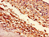 HIST1H1D Antibody - Immunohistochemistry image of paraffin-embedded human melanoma cancer at a dilution of 1:100