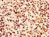 HIST1H2AI Antibody - Immunohistochemistry image at a dilution of 1:50 and staining in paraffin-embedded human glioma cancer performed on a Leica BondTM system. After dewaxing and hydration, antigen retrieval was mediated by high pressure in a citrate buffer (pH 6.0) . Section was blocked with 10% normal goat serum 30min at RT. Then primary antibody (1% BSA) was incubated at 4 °C overnight. The primary is detected by a biotinylated secondary antibody and visualized using an HRP conjugated SP system.