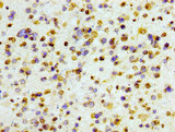 HIST1H3A Antibody - Immunohistochemistry Dilution at 1:100 and staining in paraffin-embedded human glioma cancer performed on a Leica BondTM system. After dewaxing and hydration, antigen retrieval was mediated by high pressure in a citrate buffer (pH 6.0). Section was blocked with 10% normal Goat serum 30min at RT. Then primary antibody (1% BSA) was incubated at 4°C overnight. The primary is detected by a biotinylated Secondary antibody and visualized using an HRP conjugated SP system.
