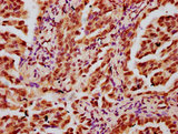 HIST1H3A Antibody - Immunohistochemistry Dilution at 1:20 and staining in paraffin-embedded human lung cancer performed on a Leica BondTM system. After dewaxing and hydration, antigen retrieval was mediated by high pressure in a citrate buffer (pH 6.0). Section was blocked with 10% normal Goat serum 30min at RT. Then primary antibody (1% BSA) was incubated at 4°C overnight. The primary is detected by a biotinylated Secondary antibody and visualized using an HRP conjugated SP system.