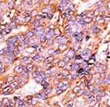 HIST1H3A Antibody - Formalin-fixed and paraffin-embedded human cancer tissue reacted with the primary antibody, which was peroxidase-conjugated to the secondary antibody, followed by AEC staining. This data demonstrates the use of this antibody for immunohistochemistry; clinical relevance has not been evaluated. BC = breast carcinoma; HC = hepatocarcinoma.