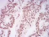 HIST2H4A Antibody - Immunohistochemical analysis of paraffin-embedded rectum cancer tissues using HIST2H4A(20Me) mouse mAb with DAB staining.