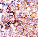 Antibody - Formalin-fixed and paraffin-embedded human cancer tissue reacted with the primary antibody, which was peroxidase-conjugated to the secondary antibody, followed by AEC staining. This data demonstrates the use of this antibody for immunohistochemistry; clinical relevance has not been evaluated. BC = breast carcinoma; HC = hepatocarcinoma.