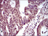 HIWI2 / PIWIL4 Antibody - IHC of paraffin-embedded rectum cancer tissues using PIWIL4 mouse monoclonal antibody with DAB staining.