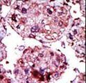 HK1 / Hexokinase 1 Antibody - Formalin-fixed and paraffin-embedded human cancer tissue reacted with the primary antibody, which was peroxidase-conjugated to the secondary antibody, followed by AEC staining. This data demonstrates the use of this antibody for immunohistochemistry; clinical relevance has not been evaluated. BC = breast carcinoma; HC = hepatocarcinoma.