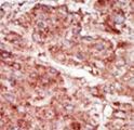 HK3 / Hexokinase 3 Antibody - Formalin-fixed and paraffin-embedded human cancer tissue reacted with the primary antibody, which was peroxidase-conjugated to the secondary antibody, followed by AEC staining. This data demonstrates the use of this antibody for immunohistochemistry; clinical relevance has not been evaluated. BC = breast carcinoma; HC = hepatocarcinoma.