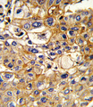 HLA-B Antibody - Formalin-fixed and paraffin-embedded human hepatocarcinoma reacted with HLA-B Antibody , which was peroxidase-conjugated to the secondary antibody, followed by DAB staining. This data demonstrates the use of this antibody for immunohistochemistry; clinical relevance has not been evaluated.