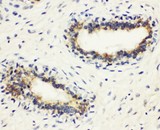 HLA-DMB Antibody - HLA-DMB antibody. IHC(P): Human Breast Cancer Tissue.