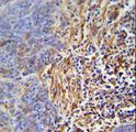 HLA-DRB5 Antibody - HLA-DRB5 Antibody immunohistochemistry of formalin-fixed and paraffin-embedded human lung carcinoma followed by peroxidase-conjugated secondary antibody and DAB staining.