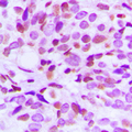 HMG20B / BRAF35 Antibody - Immunohistochemical analysis of BRAF35 staining in human breast cancer formalin fixed paraffin embedded tissue section. The section was pre-treated using heat mediated antigen retrieval with sodium citrate buffer (pH 6.0). The section was then incubated with the antibody at room temperature and detected using an HRP conjugated compact polymer system. DAB was used as the chromogen. The section was then counterstained with hematoxylin and mounted with DPX.