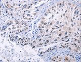 HMGB3 Antibody - Immunohistochemistry of paraffin-embedded Human lung cancer using HMGB3 Polyclonal Antibody at dilution of 1:20.
