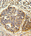 HMGCS1 / HMG-CoA Synthase 1 Antibody - Formalin-fixed and paraffin-embedded human lung carcinoma reacted with HMGCS1 Antibody , which was peroxidase-conjugated to the secondary antibody, followed by DAB staining. This data demonstrates the use of this antibody for immunohistochemistry; clinical relevance has not been evaluated.