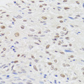 HMGN1 / HMG14 Antibody - Immunohistochemistry of paraffin-embedded human lung cancer tissue.