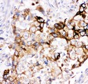 HMOX2 / Heme Oxygenase 2 Antibody - HMOX2 antibody IHC-paraffin: Human Lung Cancer Tissue.
