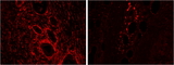 HMOX2 / Heme Oxygenase 2 Antibody - Goat Anti-HMOX2 Antibody (2µg/ml) staining of paraffin embedded Human Pancreas: cancer (left), adjacent to cancer (right). Steamed antigen retrieval with citrate buffer pH 6, Alexa594-staining.