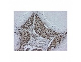 HNRNPA2B1 Antibody - Staining of paraffin lung tissue sections showing squamous cell carcinoma, using hnRNP A2B1 antibody