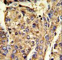 HNRNPL / hnRNP L Antibody - Formalin-fixed and paraffin-embedded human hepatocarcinoma reacted with HNRPL Antibody , which was peroxidase-conjugated to the secondary antibody, followed by DAB staining. This data demonstrates the use of this antibody for immunohistochemistry; clinical relevance has not been evaluated.