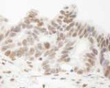 HNRNPUL1 Antibody - Detection of Human E1B-AP5 by Immunohistochemistry. Sample: FFPE section of human ovarian carcinoma. Antibody: Affinity purified rabbit anti-E1B-AP5 used at a dilution of 1500.