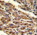 HOMER1 / Homer 1 Antibody - Formalin-fixed and paraffin-embedded human hepatocarcinoma with HOMER1 Antibody , which was peroxidase-conjugated to the secondary antibody, followed by DAB staining. This data demonstrates the use of this antibody for immunohistochemistry; clinical relevance has not been evaluated.