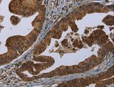 HOMER2 / Homer 2 Antibody - Immunohistochemistry of paraffin-embedded Human gastric cancer using HOMER2 Polyclonal Antibody at dilution of 1:30.