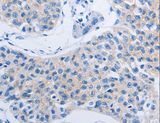 HOXA6 Antibody - Immunohistochemistry of paraffin-embedded Human lung cancer using HOXA6 Polyclonal Antibody at dilution of 1:60.