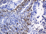 HOXD10 Antibody - IHC of paraffin-embedded Adenocarcinoma of Human endometrium tissue using anti-HOXD10 mouse monoclonal antibody. (Heat-induced epitope retrieval by 10mM citric buffer, pH6.0, 120°C for 3min).