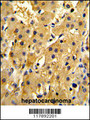 HPD Antibody - Formalin-fixed and paraffin-embedded human hepatocarcinoma reacted with HPD Antibody , which was peroxidase-conjugated to the secondary antibody, followed by DAB staining. This data demonstrates the use of this antibody for immunohistochemistry; clinical relevance has not been evaluated.