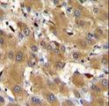 HPR Antibody - HPR Antibody immunohistochemistry of formalin-fixed and paraffin-embedded human hepatocarcinoma followed by peroxidase-conjugated secondary antibody and DAB staining.