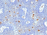 HPV16 E6 Antibody - IHC testing of FFPE human cervix with HPV-16 antibody (clone HPV16/1296). Required HIER: boil tissue sections in 10mM citrate buffer, pH 6, for 10-20 min followed by cooling at RT for 20 min.