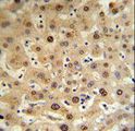 HPX / Hemopexin Antibody - HPX Antibody (RB18728) IHC of formalin-fixed and paraffin-embedded human hepatocarcinoma tissue followed by peroxidase-conjugated secondary antibody and DAB staining.