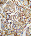 HRAS / H-Ras Antibody - Formalin-fixed and paraffin-embedded human lung carcinoma tissue reacted with HRAS antibody , which was peroxidase-conjugated to the secondary antibody, followed by DAB staining. This data demonstrates the use of this antibody for immunohistochemistry; clinical relevance has not been evaluated.