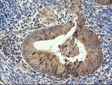 HRAS / H-Ras Antibody - IHC of paraffin-embedded Adenocarcinoma of Human endometrium tissue using anti-HRAS mouse monoclonal antibody.