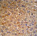 HRG Antibody - HRG Antibody (RB18729) IHC of formalin-fixed and paraffin-embedded human hepatocarcinoma tissue followed by peroxidase-conjugated secondary antibody and DAB staining.
