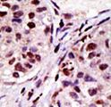 HRS / HGS Antibody - Formalin-fixed and paraffin-embedded human cancer tissue reacted with the primary antibody, which was peroxidase-conjugated to the secondary antibody, followed by AEC staining. This data demonstrates the use of this antibody for immunohistochemistry; clinical relevance has not been evaluated. BC = breast carcinoma; HC = hepatocarcinoma.