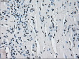 HSD17B10 / HADH2 Antibody - IHC of paraffin-embedded Carcinoma of Human thyroid tissue using anti-HSD17B10 mouse monoclonal antibody.