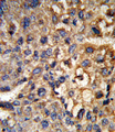 HSD17B12 Antibody - Formalin-fixed and paraffin-embedded human hepatocarcinoma reacted with HSD17B12 Antibody , which was peroxidase-conjugated to the secondary antibody, followed by DAB staining. This data demonstrates the use of this antibody for immunohistochemistry; clinical relevance has not been evaluated.