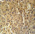 HSD17B13 Antibody - DHB13 Antibody immunohistochemistry of formalin-fixed and paraffin-embedded human hepatocarcinoma followed by peroxidase-conjugated secondary antibody and DAB staining.