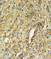 HSD17B2 Antibody - HSD17B2 Antibody IHC of formalin-fixed and paraffin-embedded human prostate carcinoma followed by peroxidase-conjugated secondary antibody and DAB staining.