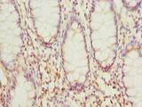 HSDL2 Antibody - Immunohistochemistry of paraffin-embedded human colon cancer using antibody at dilution of 1:100.