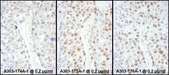 HSF1 Antibody - Detection of Human HSF1 by Immunohistochemistry. Samples: FFPE sections of human ovarian carcinoma. Antibody: Affinity purified rabbit anti-HSF1 used at a dilution of 1:1000 (0.2 ug/ml) (right). Detection: DAB.