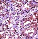 HSF1 Antibody - HSF1 Antibody immunohistochemistry of formalin-fixed and paraffin-embedded human kidney carcinoma followed by peroxidase-conjugated secondary antibody and DAB staining.